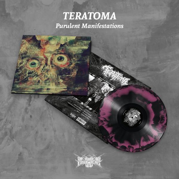 TERATOMA Purulent Manifestations (ltd.)